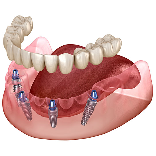 IMPLANT RETAINED PARTIALS 
