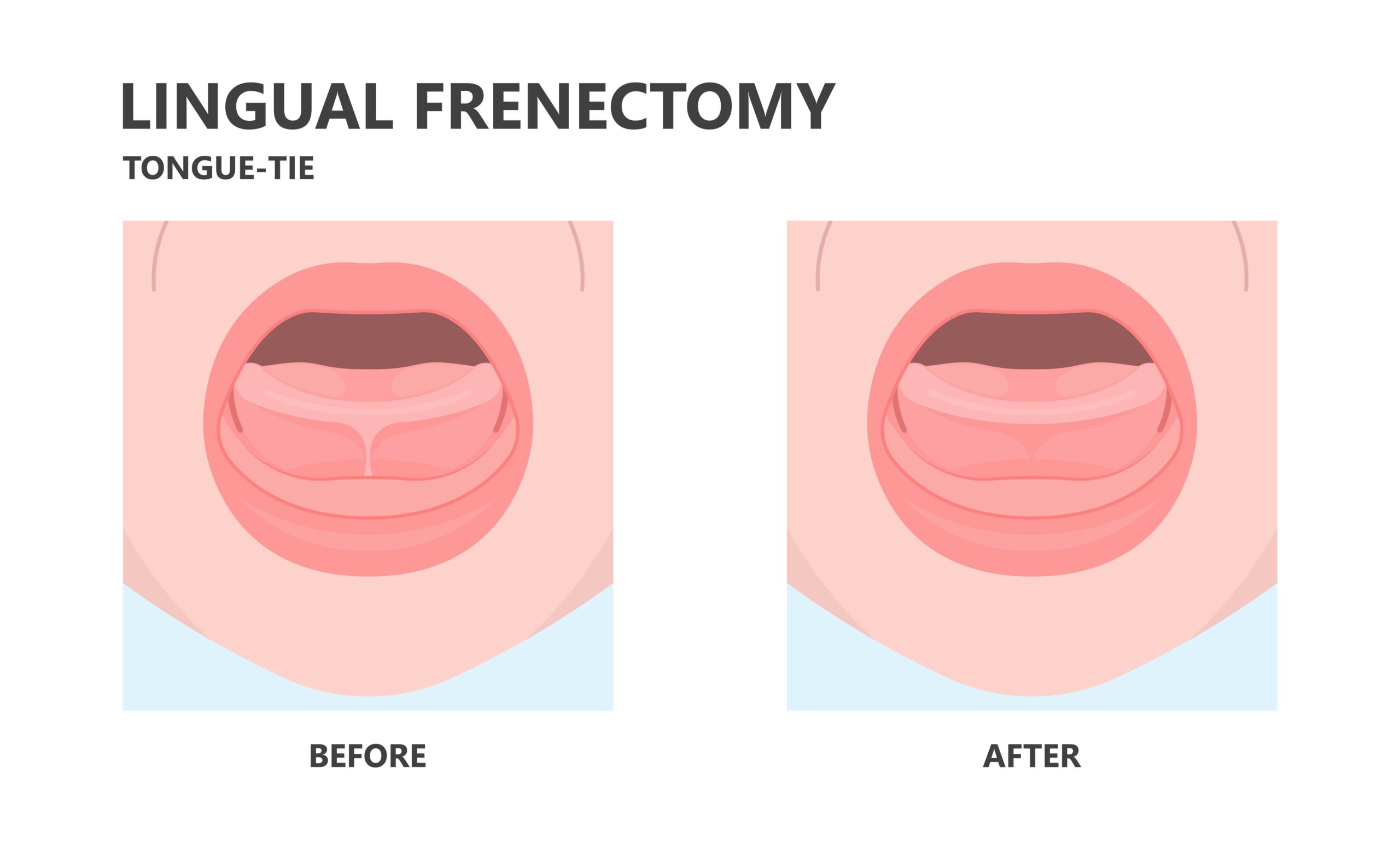 lingual frenectomy 