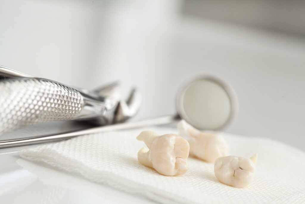 Tooth extractions