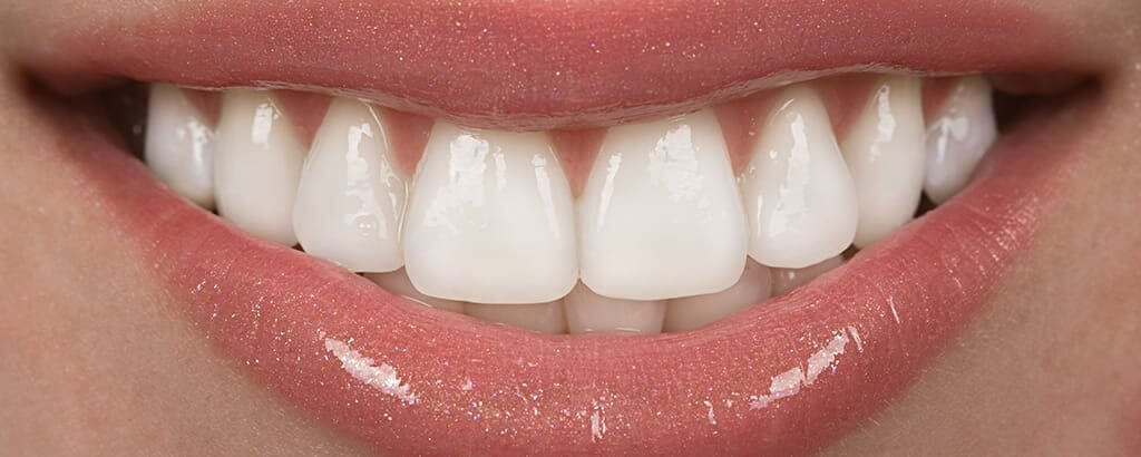 Veneers