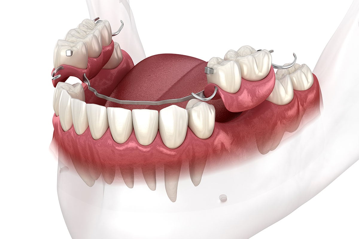 Removable partial denture, mandibular prosthesis. Medically accu